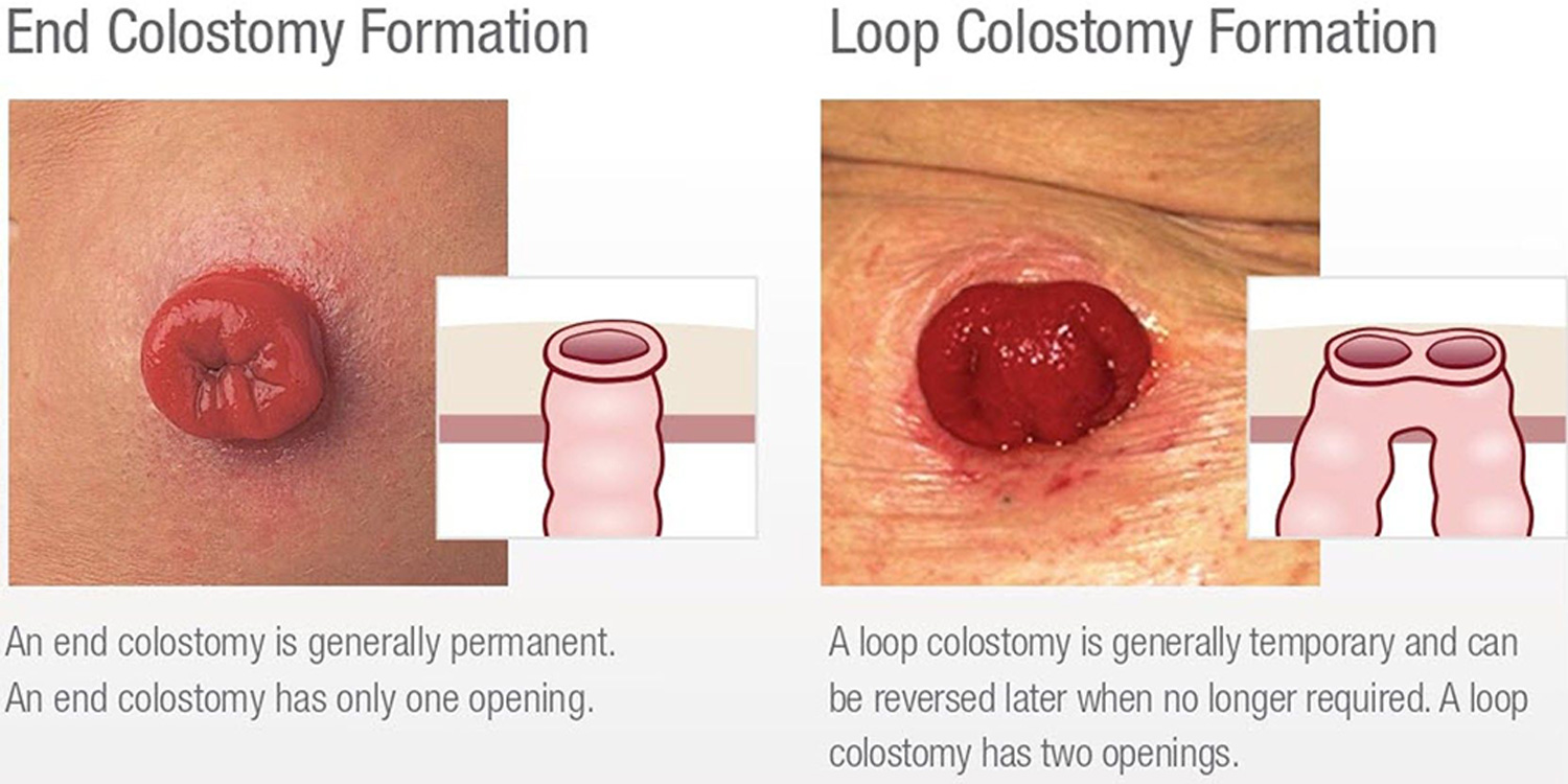 The Main Differences Between Ileostomy vs Colostomy Bag