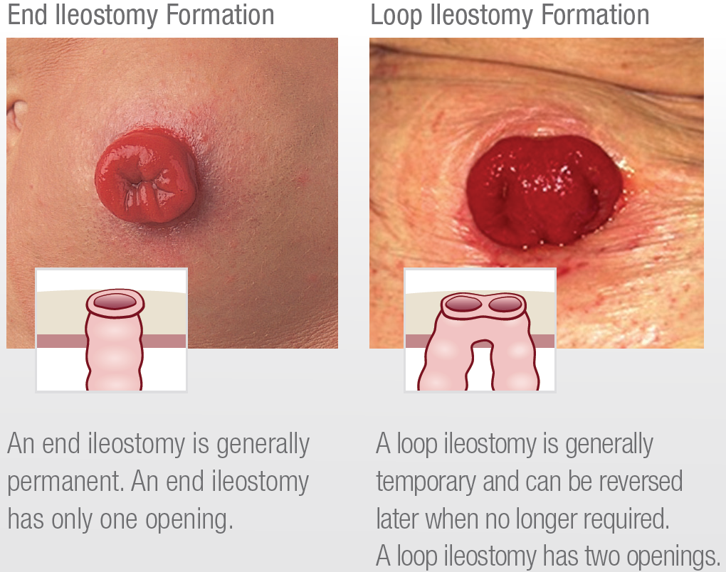 The Main Differences Between Ileostomy vs Colostomy Bag
